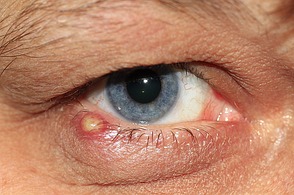 Entzündung am Auge (Gerstenkorn)