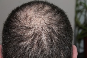 Auch homöopathische Behandlungen kann den Haarwuchs stärken